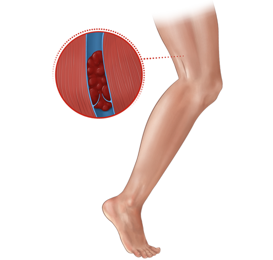 Deep Vein Thrombosis | Penumbra Patient Condition