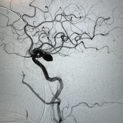 Angiogram of MIDWAY 62 in a vessel