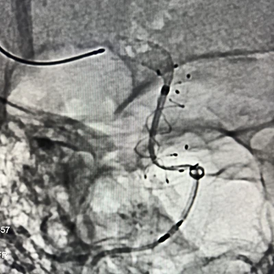 Angiogram of MIDWAY 62 in a vessel