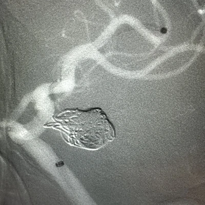 Angiogram of MIDWAY 62 in a vessel