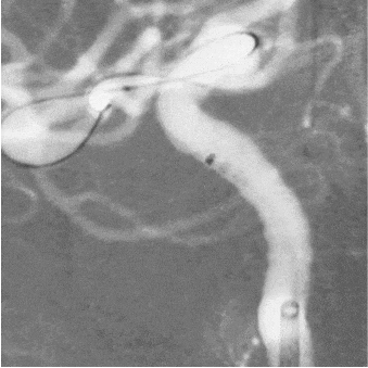 angiogram of MIDWAY 43 entering a vessel