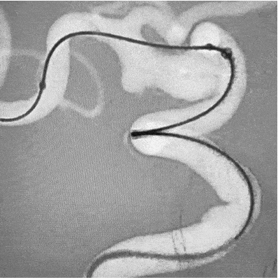 Angiogram of MIDWAY 43 in a vessel