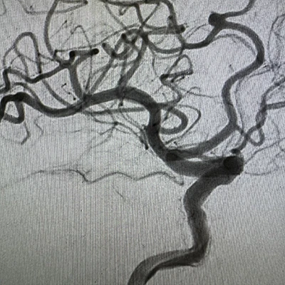 Angiogram of MIDWAY 43 in a vessel