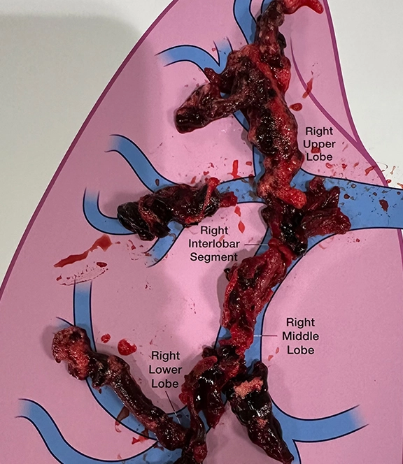 Blood Clots placed on a lung diagram