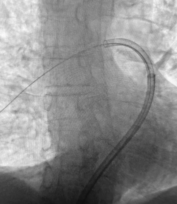 angiogram of tracking of ELEMENT