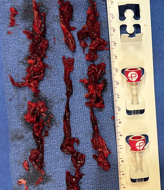 blood clots on a blue towel