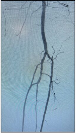 Post-thrombectomy angiogram of left anterior tibial and tibioperoneal