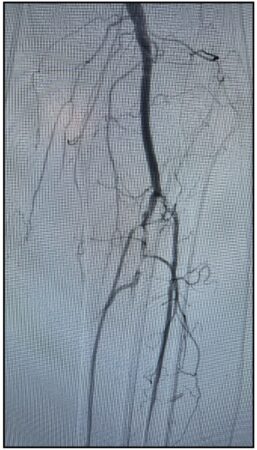 Initial angiogram of occlusion in the anterior tibial and tibioperoneal arteries